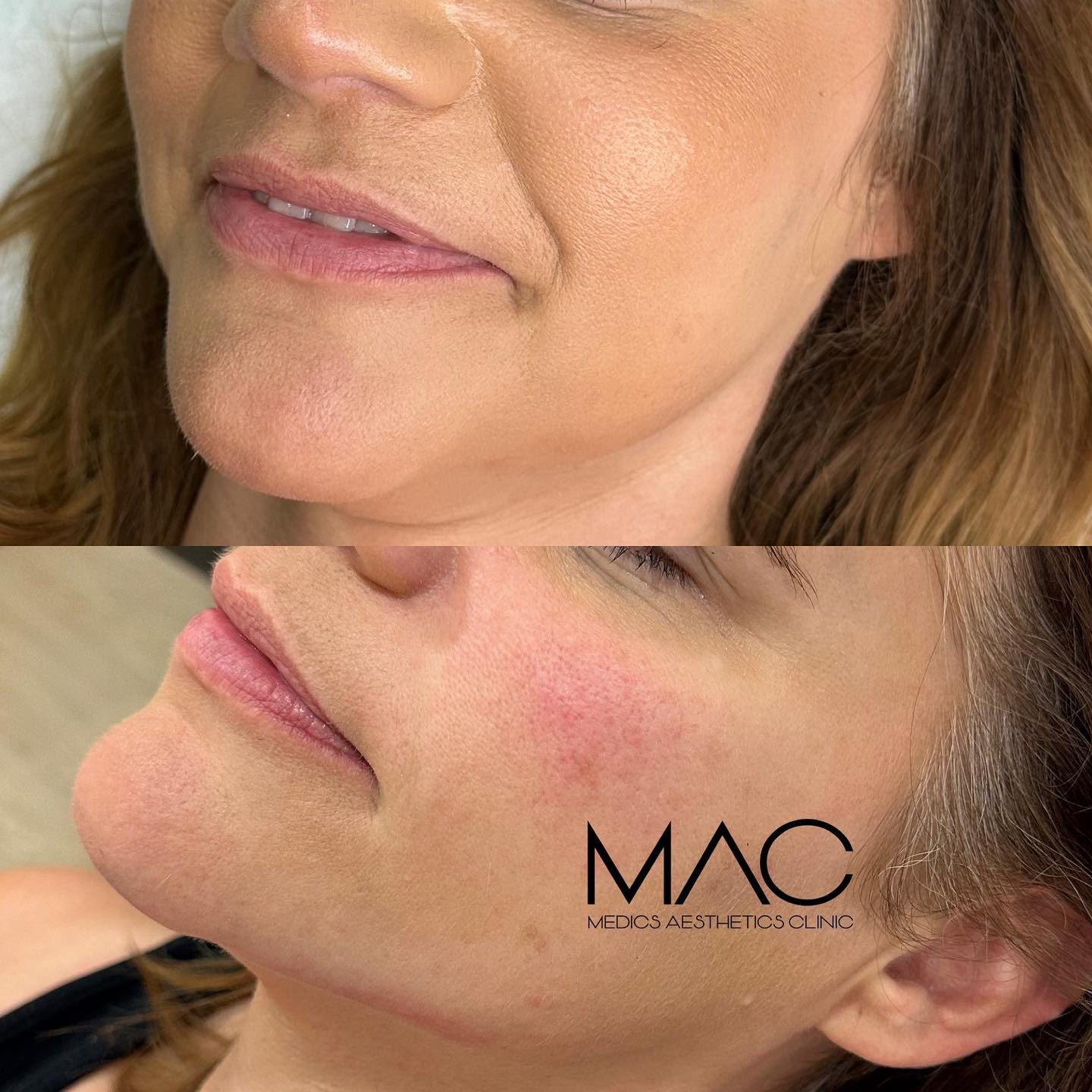 Lower face and skin before and after