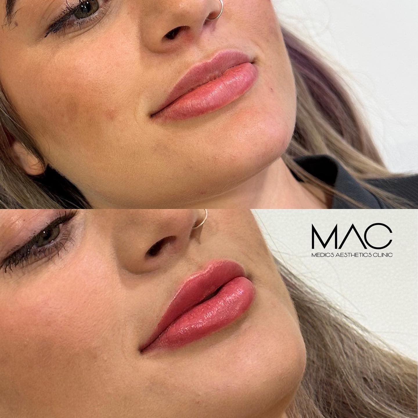 Lip filler before and after