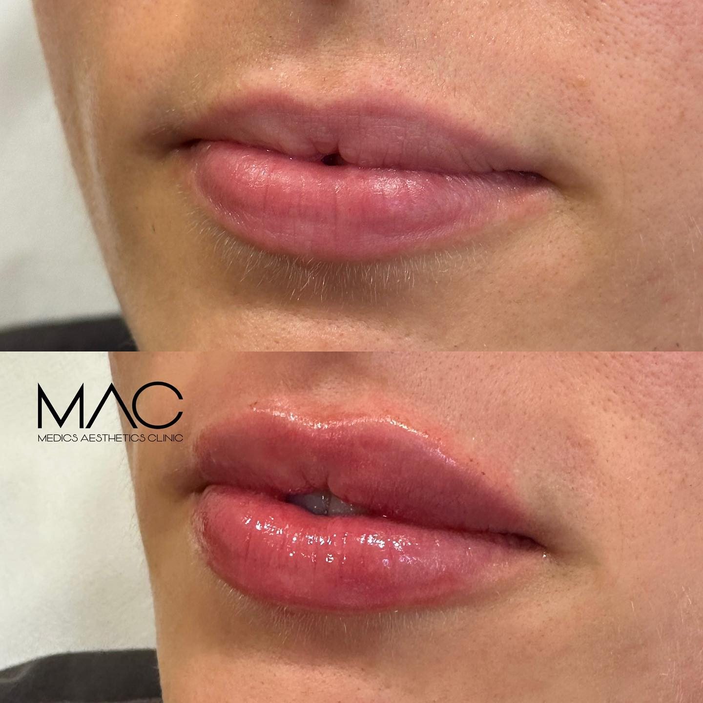 Lip filler before and after