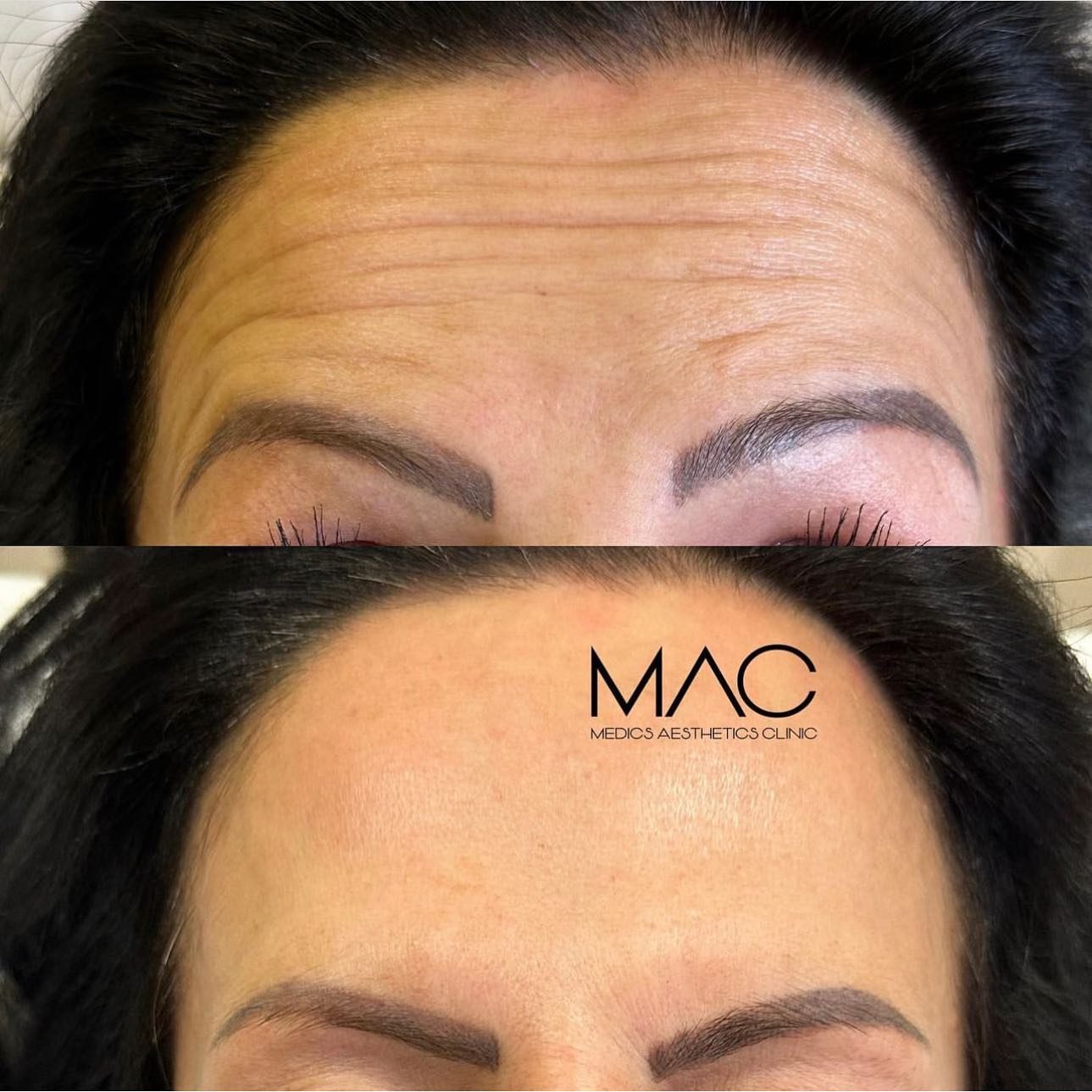 Anti-wrinkle before and after