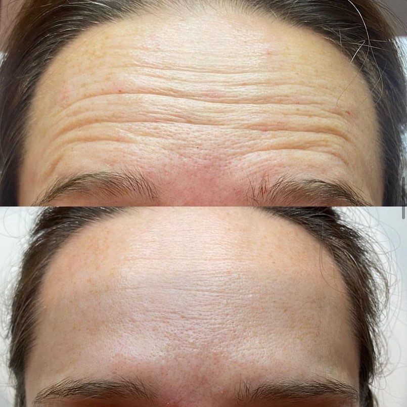 Anti-wrinkle forehead before and after