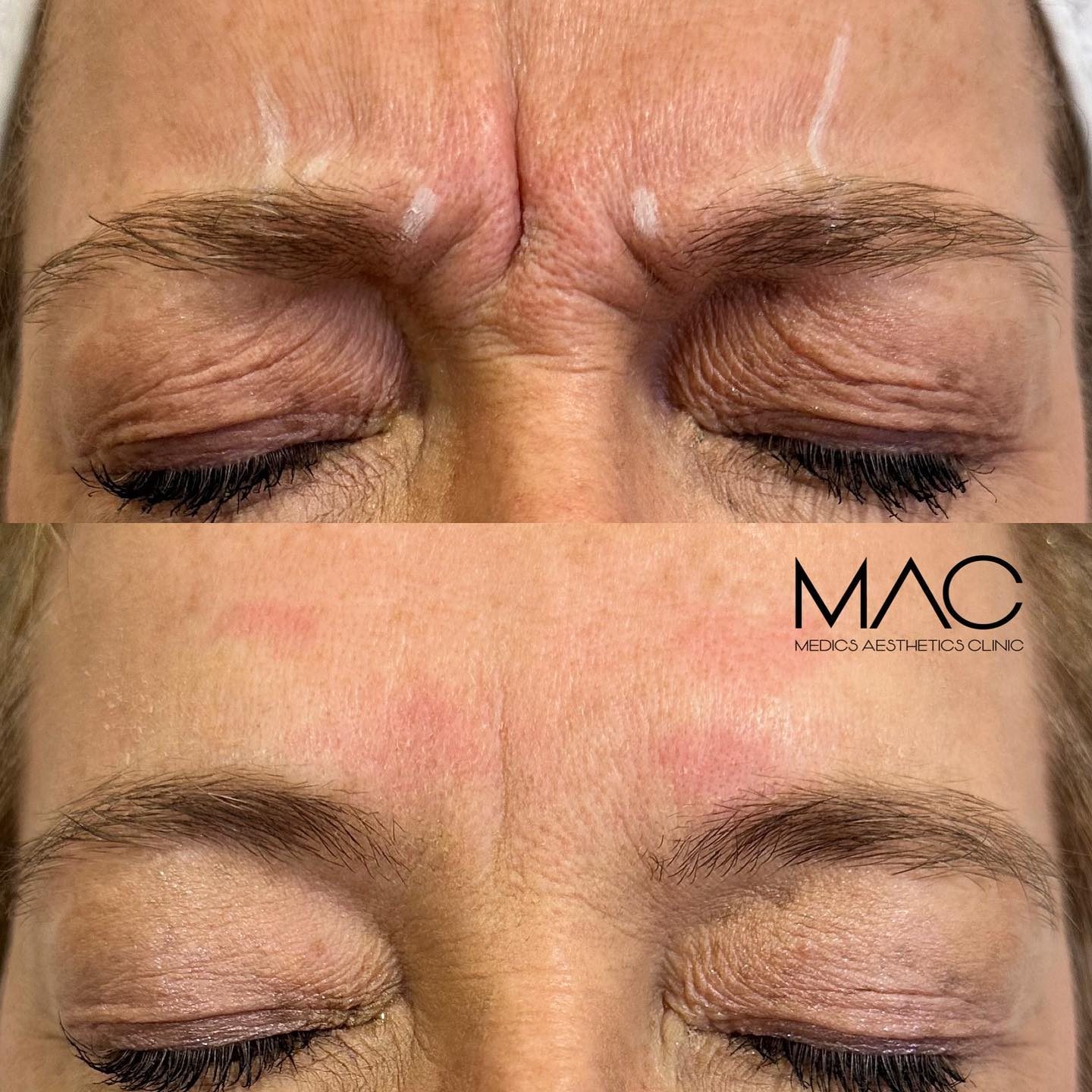 Anti-wrinkle frown lines before and after
