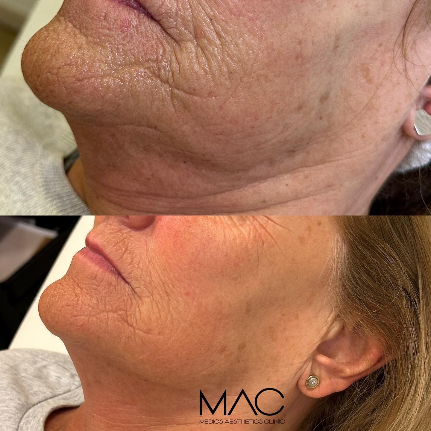 Jawline and neck before and after
