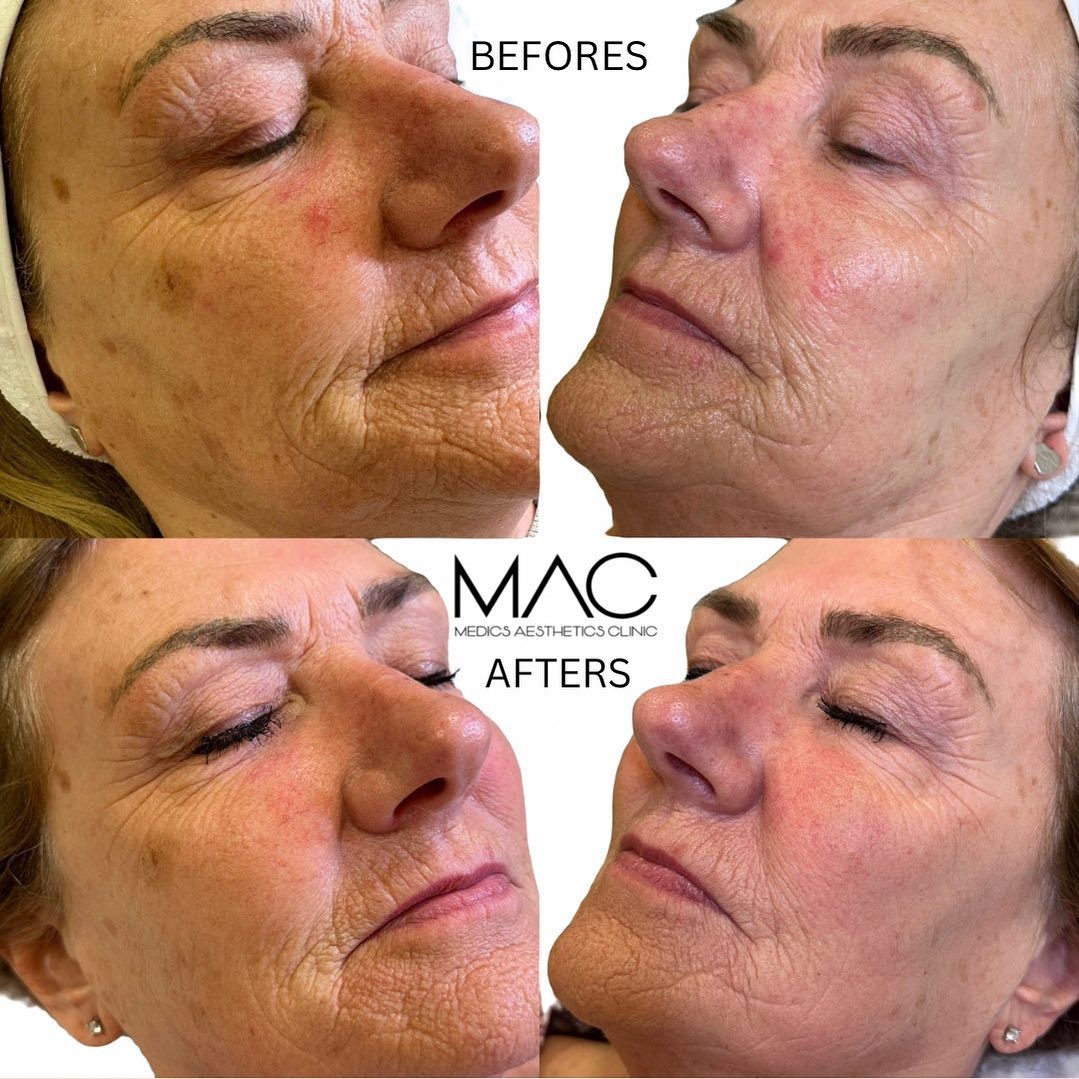 Skin rejuvenation before and after