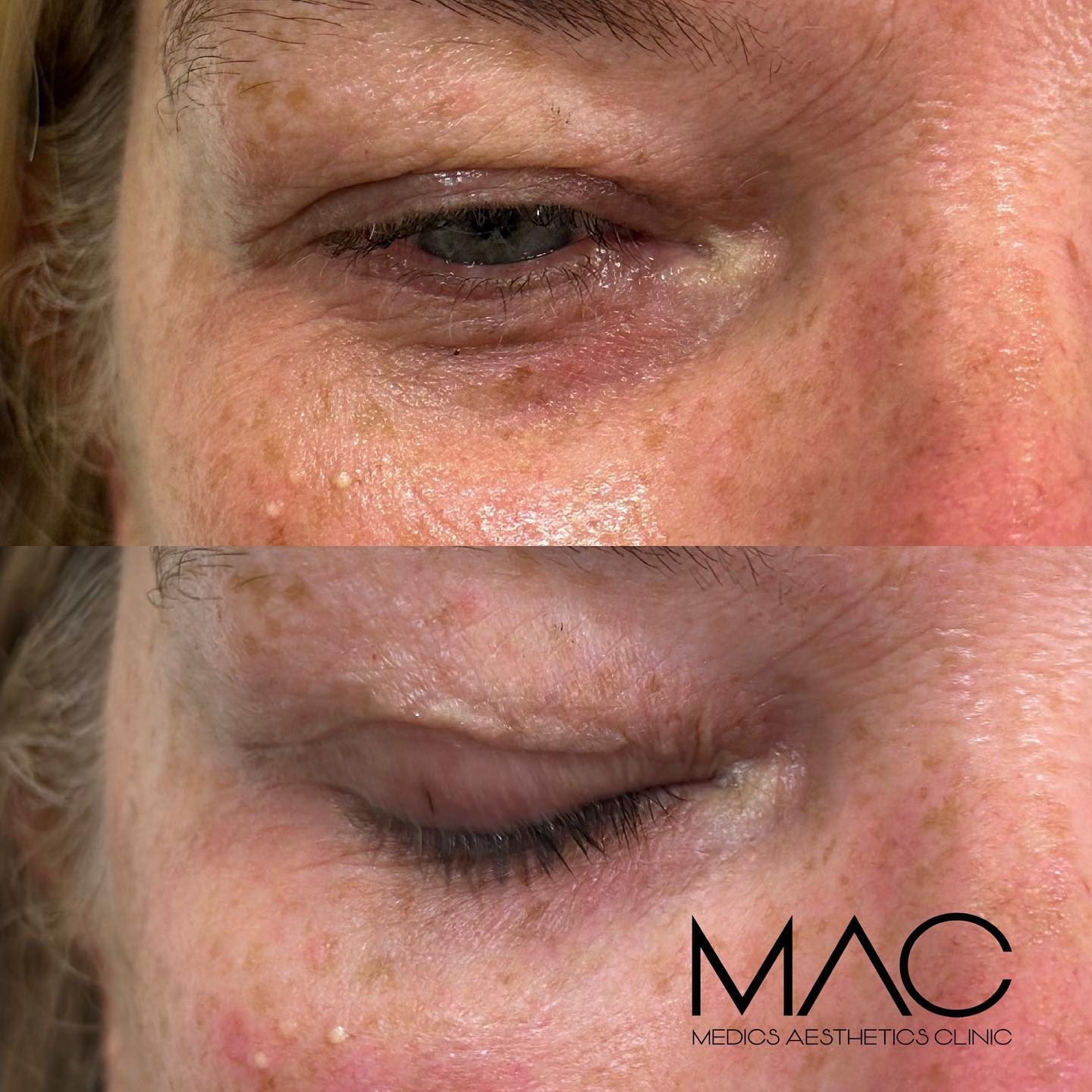 Under-eye before and after