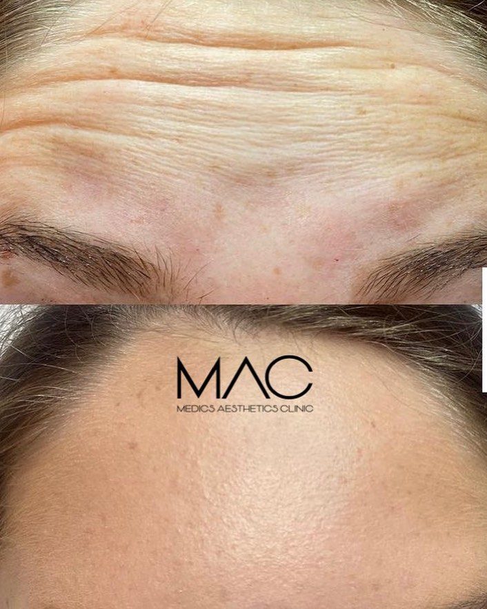Anti-wrinkle forehead before and after at Medics Aesthetics Clinic