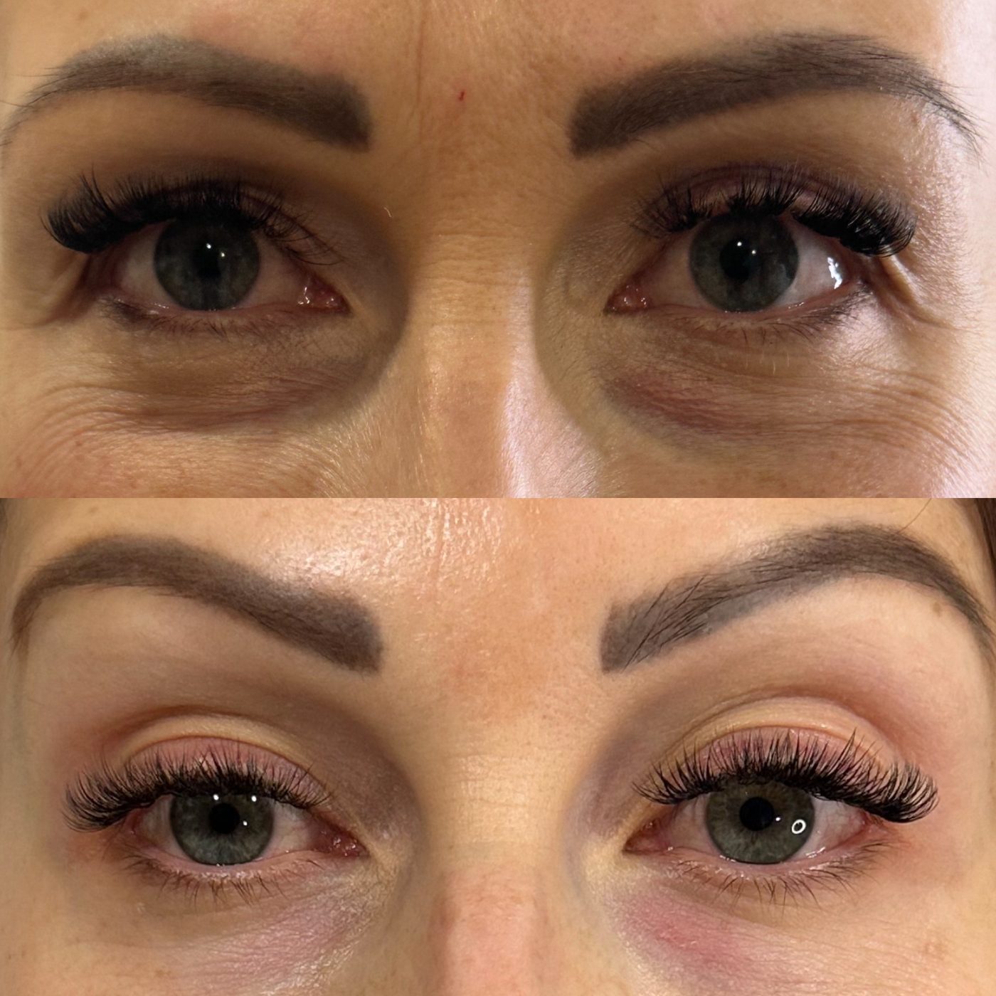 Polynucleotide skin regeneration treatment at Medics Aesthetics Clinic