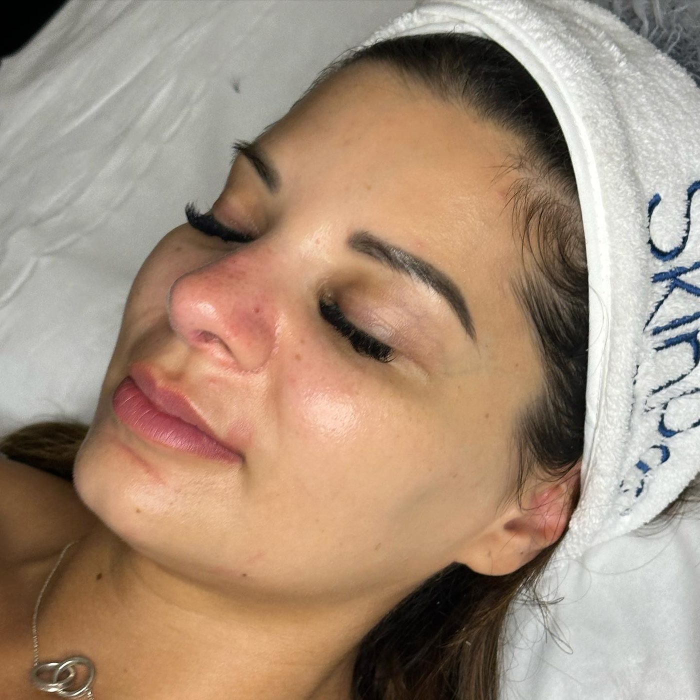 SkinPen microneedling treatment at Medics Aesthetics Clinic